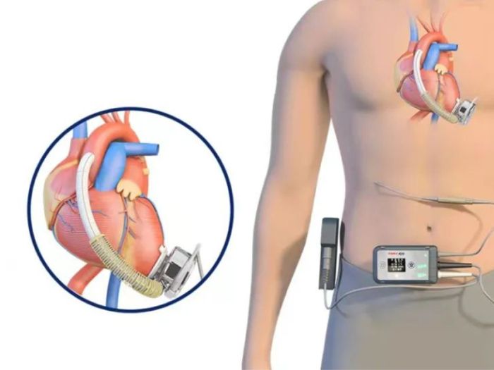 Application of ultrasonic heat sealing machine in medical industry