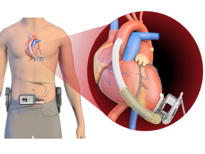 Application analysis of ultrasonic heat sealing machine in medical industry